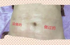 去妊娠紋機器多少錢一臺？美容院去除妊娠紋機器設備價格